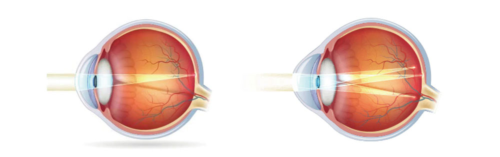 What is astigmatism?